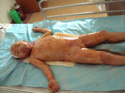 ������(y��ng)�ß����񝙱�¶�������ί���(chu��ng)����Ϳ�����񝙟����࣬��С�r(sh��)�Qˎһ�����@��Һ�����ڄ�(chu��ng)��ı��F(xi��n)���������o����B(t��i)�������C��MEBT/MEBO��ֹ��Ч����